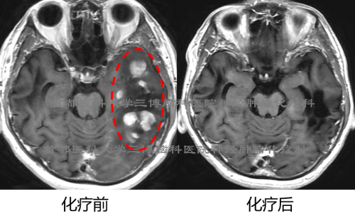 三博脑科张俊平研究成果在第29届美国神经肿瘤年会进行大会口头报告