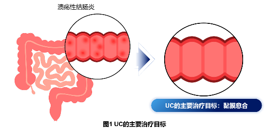 每日一次口服一线先进疗法！伊曲莫德重塑溃疡性结肠炎长程管理格局