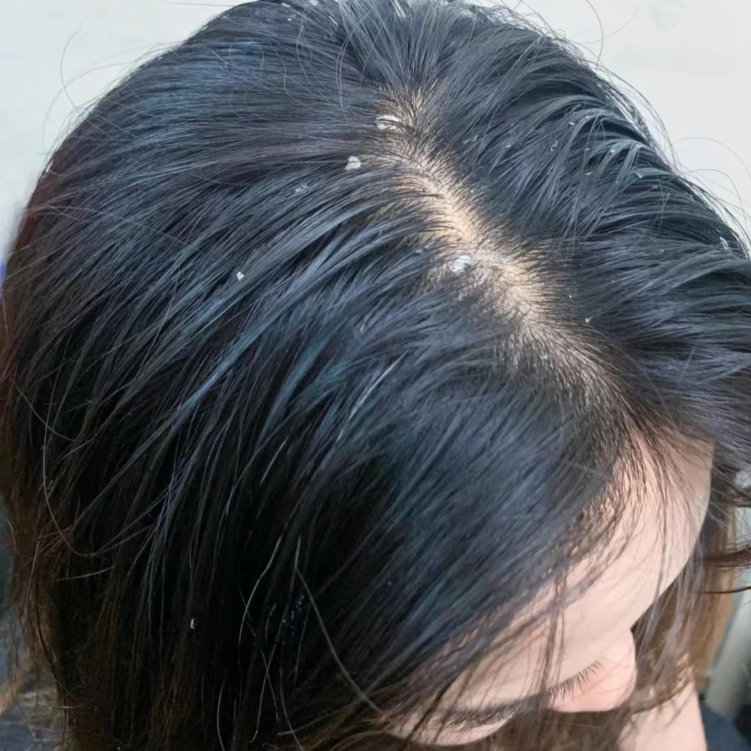 女生去头皮屑最好的方法是什么？‌科学去屑，重现柔亮发丝‌
